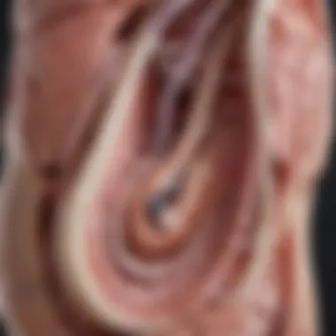 Illustration depicting the anatomy of the aortic valve with sclerotic changes.