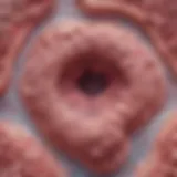 Histological view of supraglottic squamous cell carcinoma