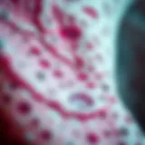 Histopathological features of Stage 1 endometrial cancer