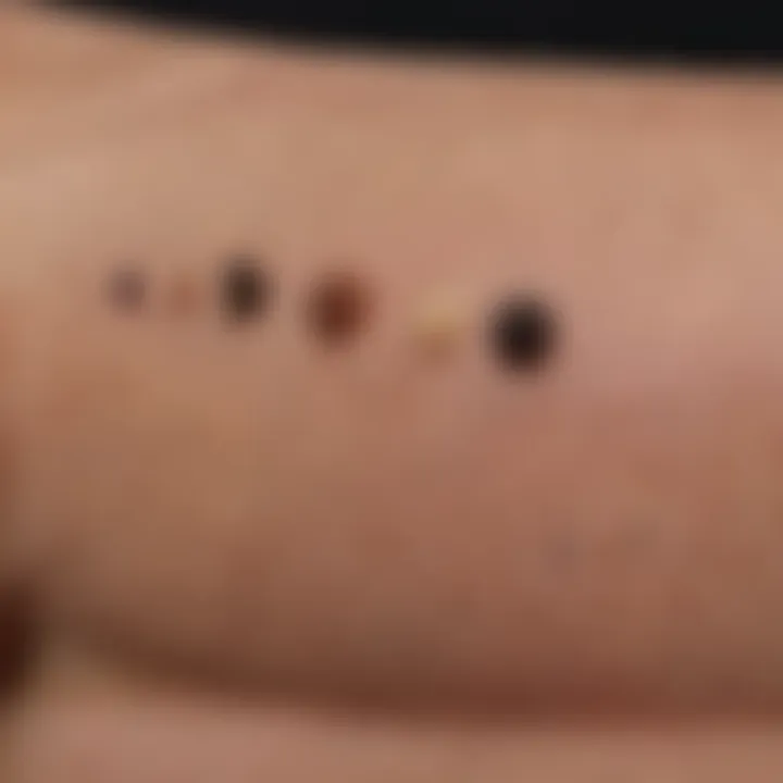 Diagram showing melanoma progression stages